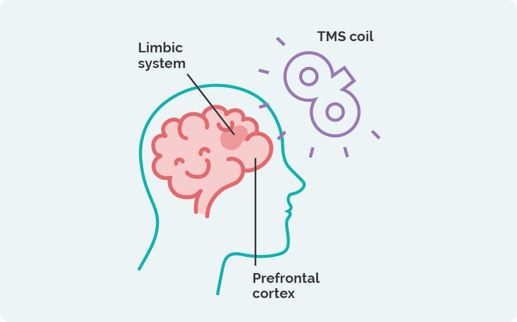how to treat ptsd TMS Therapy how to help with ptsd tms therapy for ptsd how to get rid of ptsd